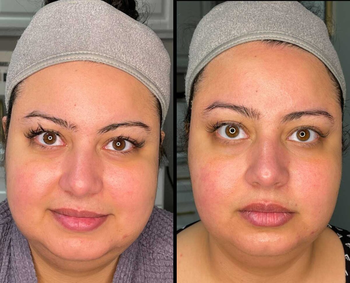 RF Skin Tightening / Facial & Body Contouring Contoura MedSpa