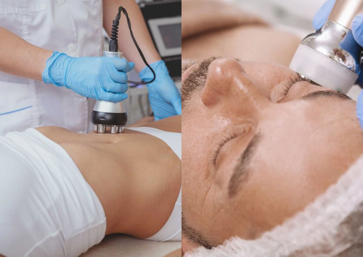 side by side photo of woman and man receiving RF Skin Tightening procedure