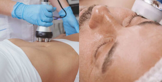 side by side photo of woman and man receiving RF Skin Tightening procedure