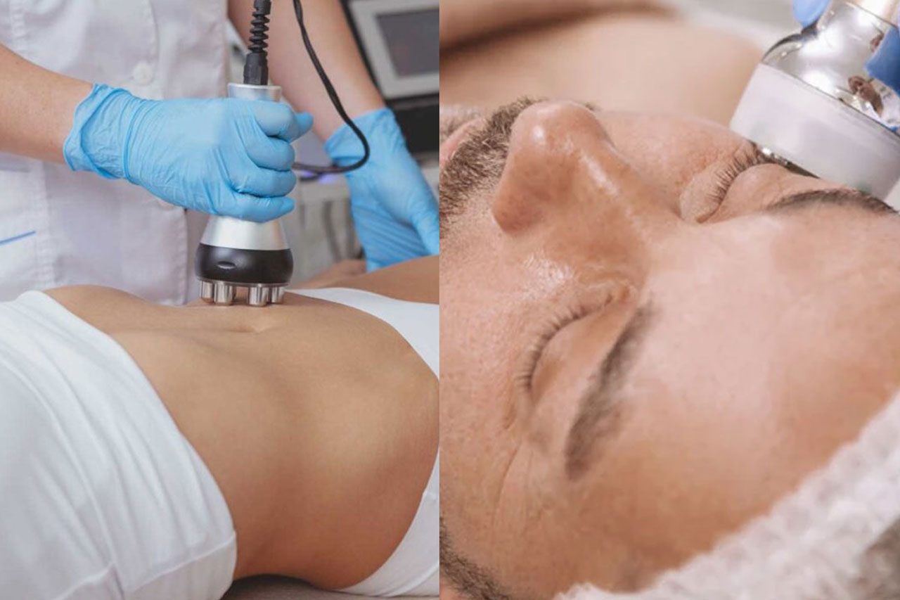 side by side photo of woman and man receiving RF Skin Tightening procedure