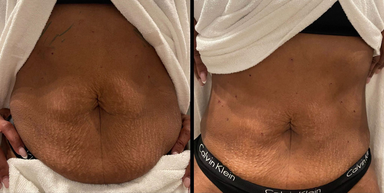 Photo of abdominal thread lift results before and after in Atlanta.