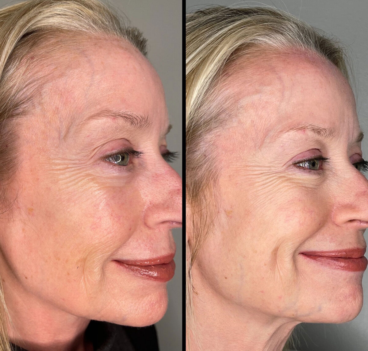 PDO Thread Lift Contoura MedSpa Metro Atlanta Area