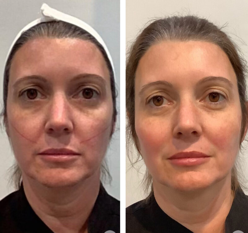 PDO Thread Lift Contoura MedSpa Metro Atlanta Area