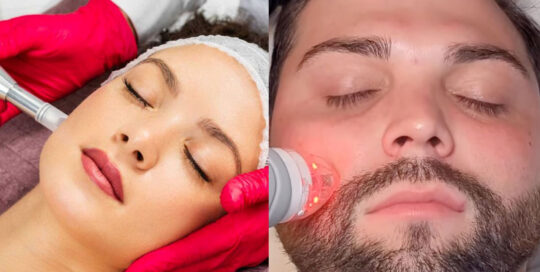MedSpa Skin Treatments in metro Atlanta and Alpharetta in north Georgia - side by side photo of woman receiving Vivace microneedling and man receiving Vivace microneedling.