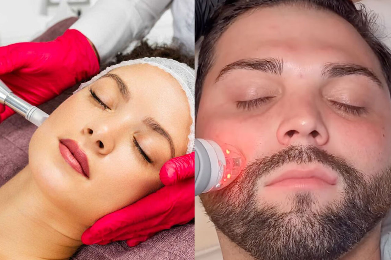 side by side photo of woman receiving Vivace microneedling and man receiving Vivace microneedling.