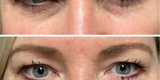 PRP Under Eye treatments for men in Atlanta