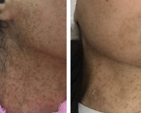 Before and After comparison photo of LC Bright Stem Cell Skin Renewal Improvement Treatment