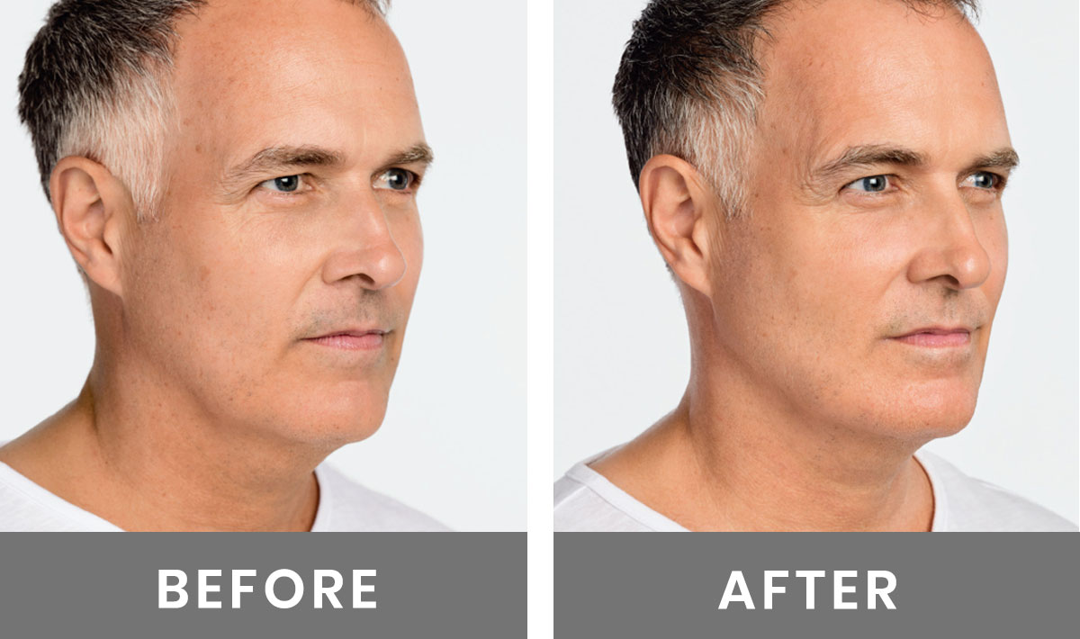 Before and after photos of middle age man and the positive effects of Radiesse fillers on his face.