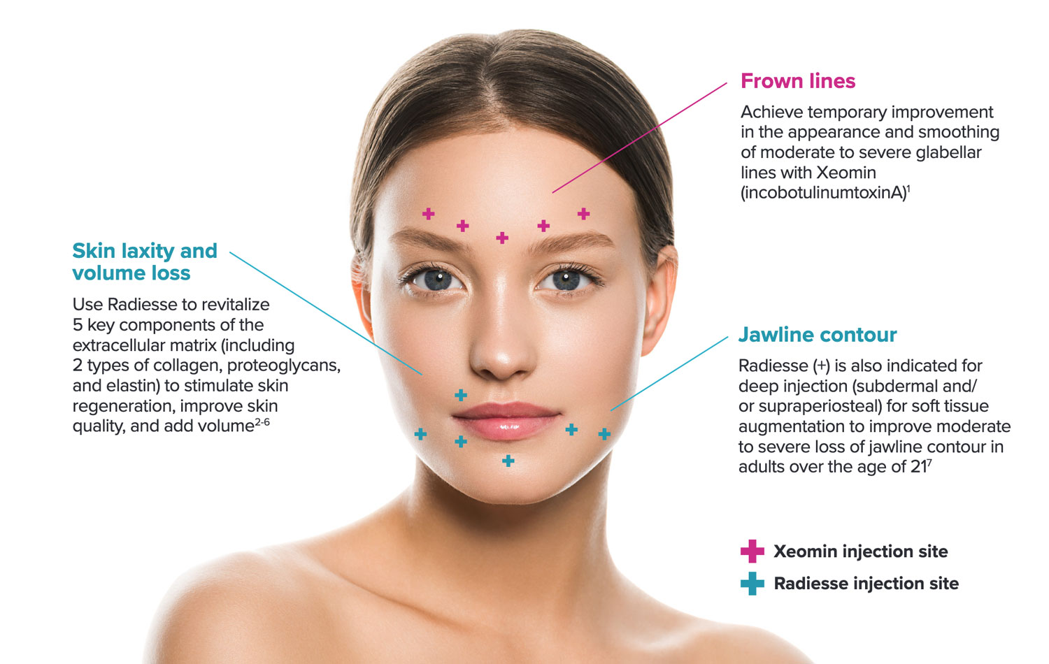 Face diagram showing injection sites for Radiesse and Xeomin fillers.