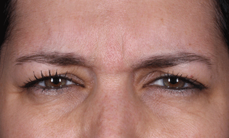 photo of woman's forehead after 6 months of DAXXIFY®